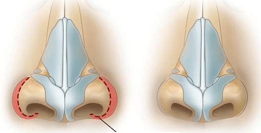Verkleinerung des Nasenlochs