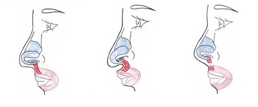 Verkürzung eines Teils des Nasenmuskels