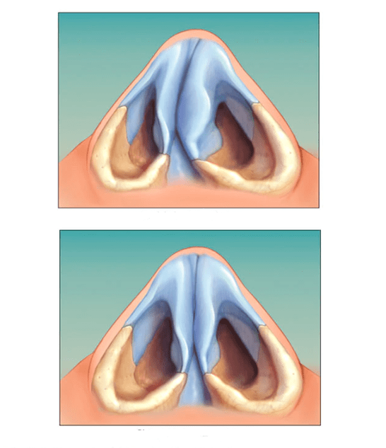 richtiges Nasenseptum