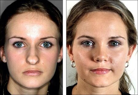 vor und nach der Nasenkorrektur