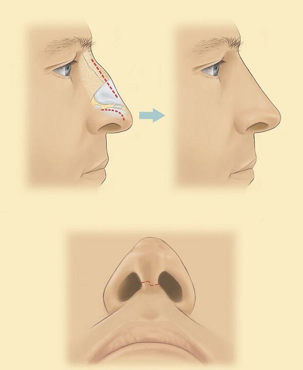 Schema zur Nasenkorrektur