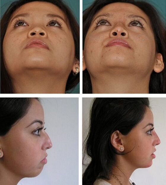 Fotos vor und nach Nasenkorrektur ohne Operation