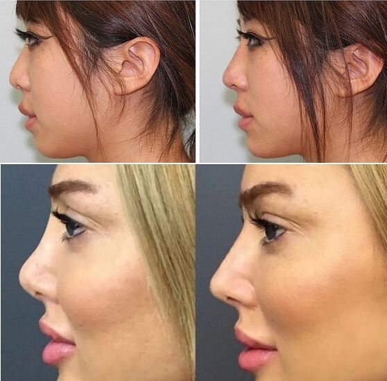 Fotos vor und nach nicht-chirurgischer Nasenkorrektur