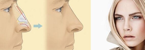 Korrektur der Nasenform mit nicht-chirurgischer Nasenkorrektur