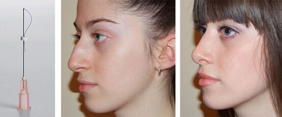 vor und nach Nasenkorrektur bei Mesophilen