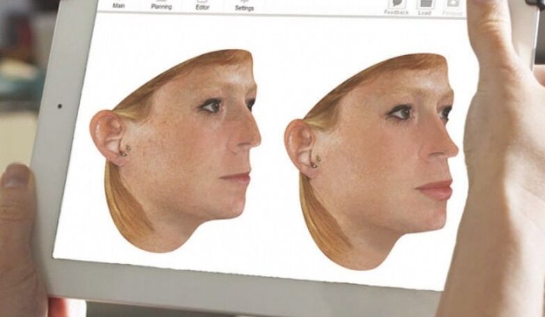 Computermodellierungsmethode der Nase vor der Nasenkorrektur