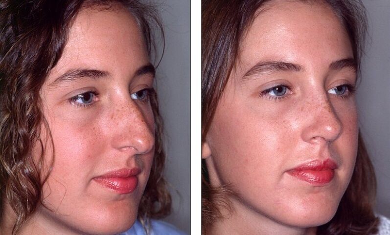 Nase vor und nach fehlgeschlagener Nasenkorrektur