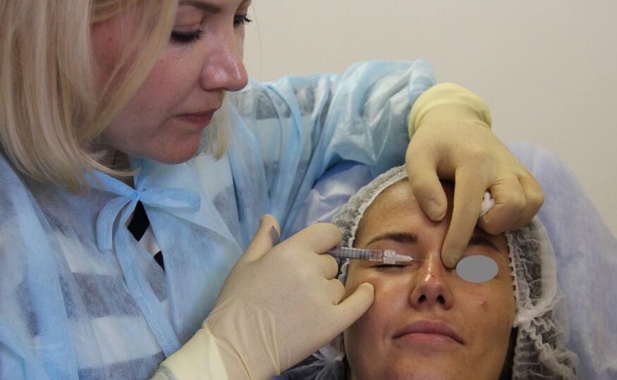 Nasenkorrektur mit Fillern zur Korrektur der Nase nach erfolgloser Operation