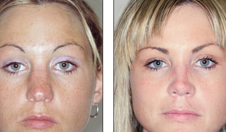 Vor und nach fehlgeschlagener Nasenkorrektur