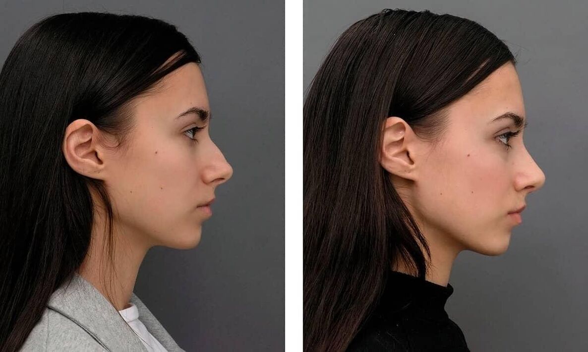 Fotos vor und nach der Nasenkorrektur