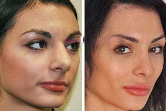 Nase vor und nach plastischer Chirurgie