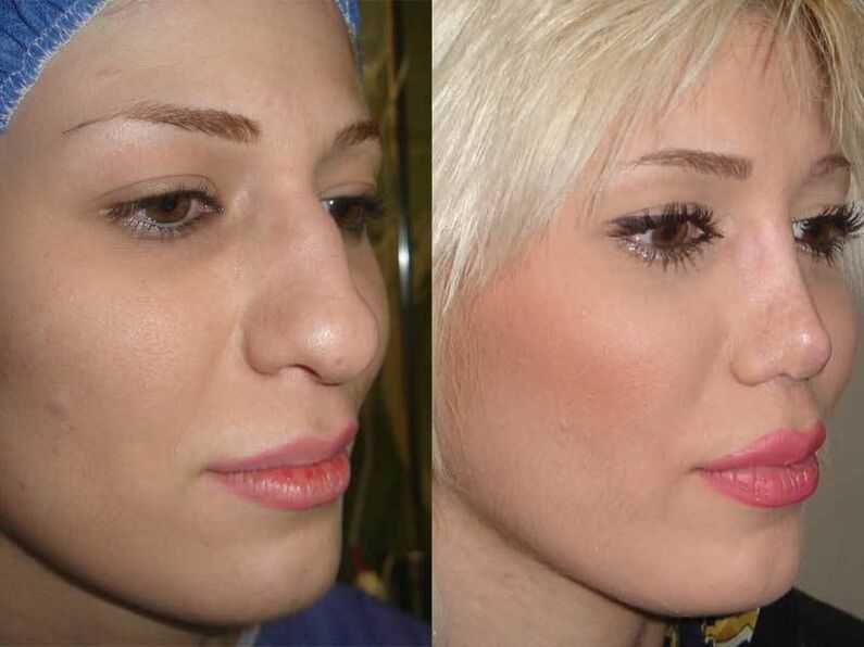 vor und nach der Nasenkorrektur
