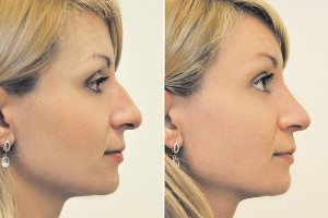 Nicht-chirurgische Nasenkorrektur Foto vor und nach